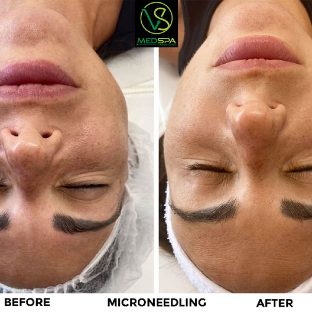 Microneedling Facial Vs Medspa Laser Hair Removal Clinic