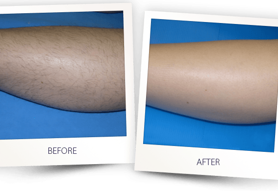 Thinking About Laser Hair Removal What You Need to Know