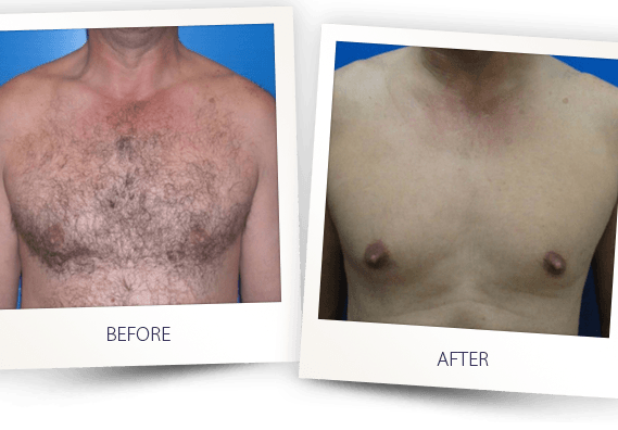 full body hair removal for male महलओ क बलकल नह पसद परष क  छत क बल यह जन इनस छटकर पन क तरक  ways to remove  unwanted chest and back hair