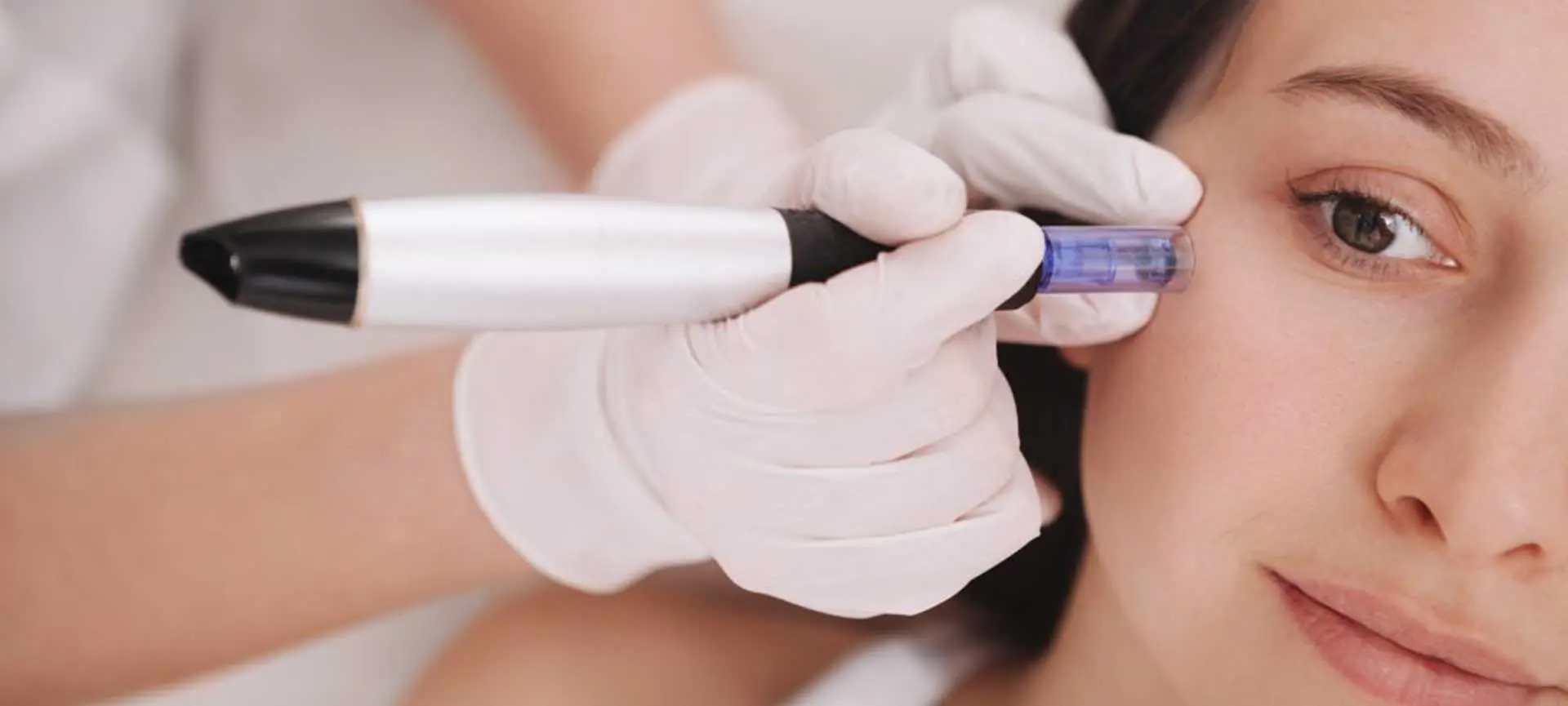 Microneedling for Acne Scars Solution