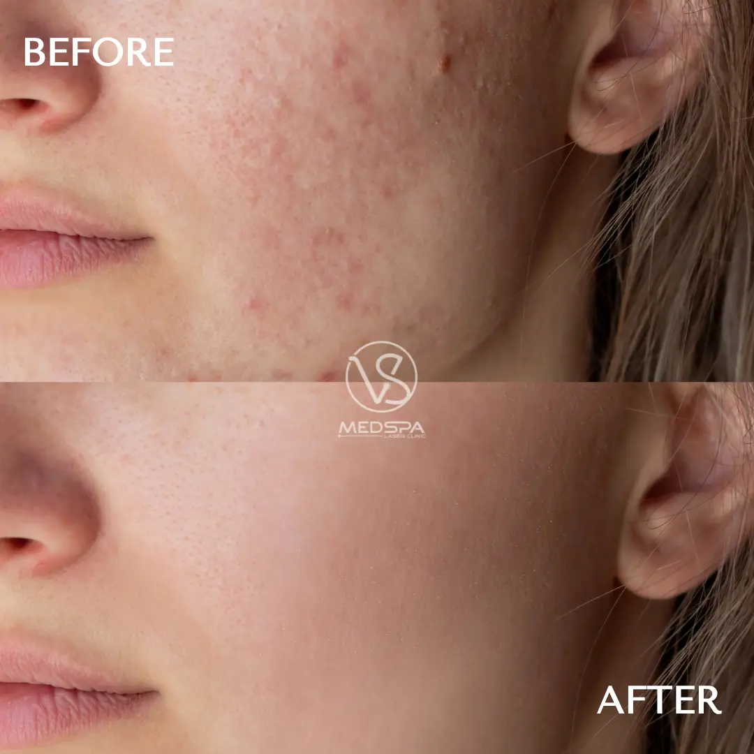 Before and After Results of Microneedling for Acne Scars