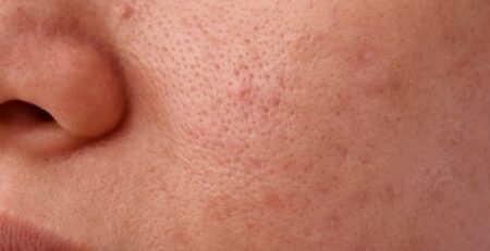 Scar Removal Toronto