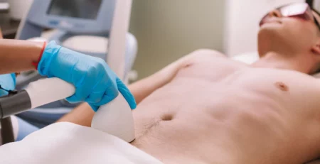 laser hair removal for men's privates